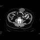 Scar hernia after laparoscopy: CT - Computed tomography